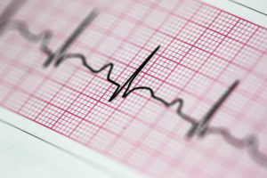 electrocardiogram print out